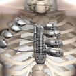 3D imagery showing the titanium rib cage in the patients body