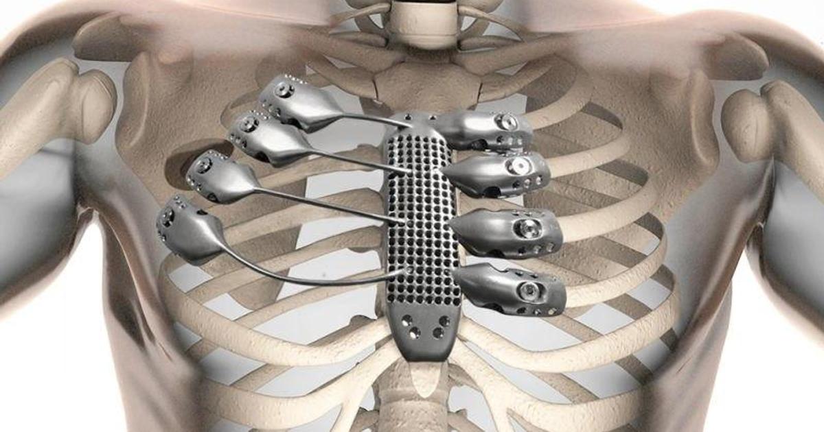 The world's first 3D-printed titanium rib cage is amazing | Pulse Ghana