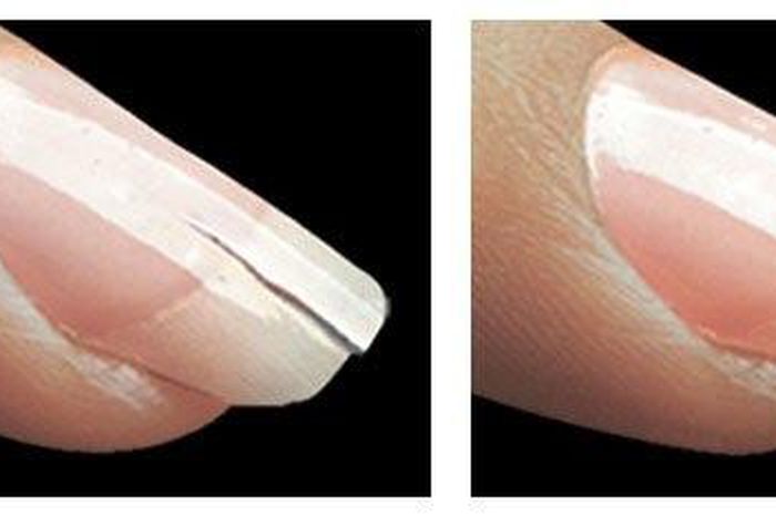 Broken/cracked nails are common but they can be fixed