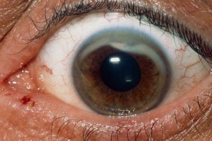 ___3778133___https:______static.pulse.com.gh___webservice___escenic___binary___3778133___2015___5___20___13____83089650_m1550397-scarred_cornea-spl