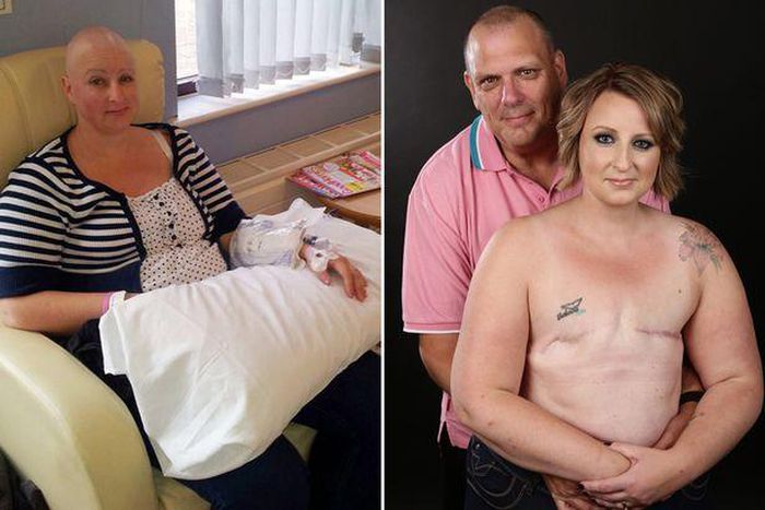 Cancer survivor, Alison Hawkes and husband, Ian Hawkes in a topless photoshoot