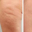 Cellulite