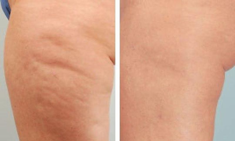 Cellulite