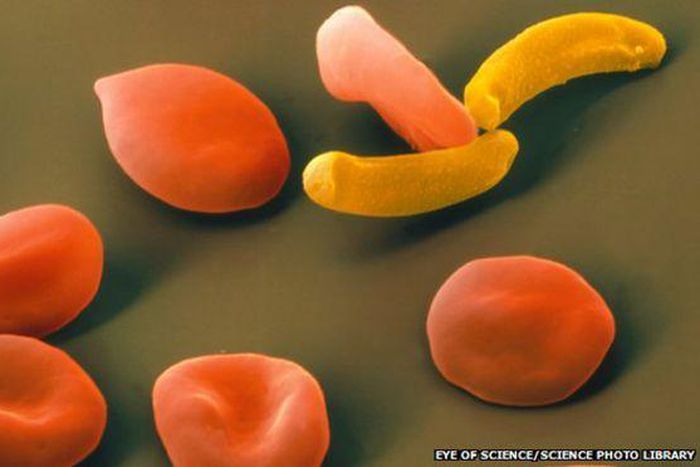 ___3737842___https:______static.pulse.com.gh___webservice___escenic___binary___3737842___2015___5___8___18____82836260_red_blood_cells_with_plasmodium-spl