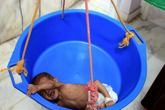 A Yemeni child suffering from severe malnutrition is weighed at a hospital in Yemen's northwestern Hajjah province