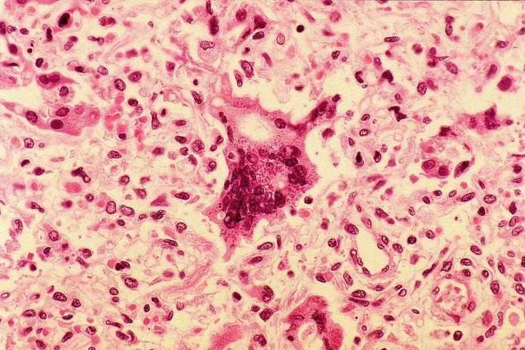 NMA pledges to eradicate measles by 99% from Nigeria