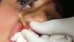 ___4082230___https:______static.pulse.com.gh___webservice___escenic___binary___4082230___2015___8___18___16___A-young-woman-has-a-maggot-removed-from-her-lip