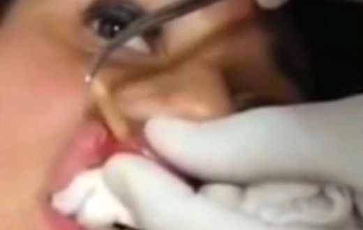 ___4082230___https:______static.pulse.com.gh___webservice___escenic___binary___4082230___2015___8___18___16___A-young-woman-has-a-maggot-removed-from-her-lip