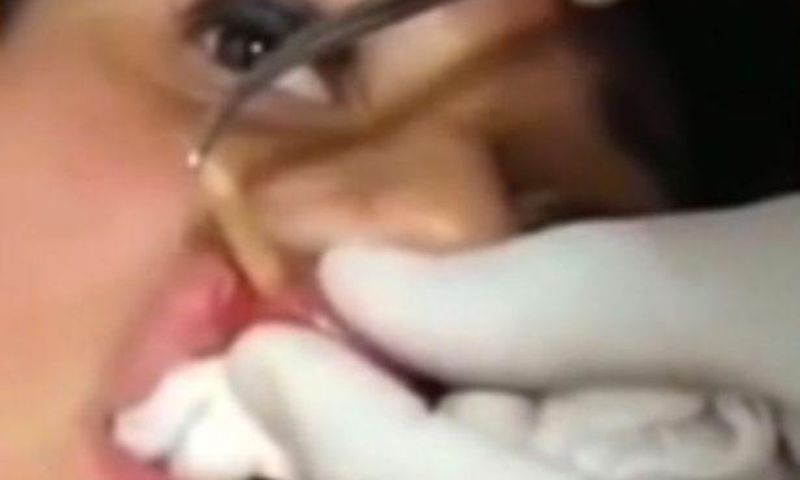 ___4082230___https:______static.pulse.com.gh___webservice___escenic___binary___4082230___2015___8___18___16___A-young-woman-has-a-maggot-removed-from-her-lip