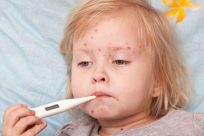 ___3935802___https:______static.pulse.com.gh___webservice___escenic___binary___3935802___2015___7___3___16___Sick-child-with-the-measles-Shutterstock-800x430