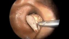 Bug removed from ear