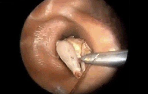 Bug removed from ear