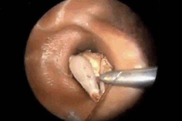 Bug removed from ear