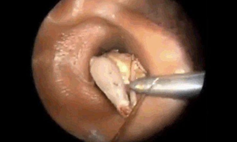 Bug removed from ear