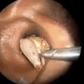 Bug removed from ear