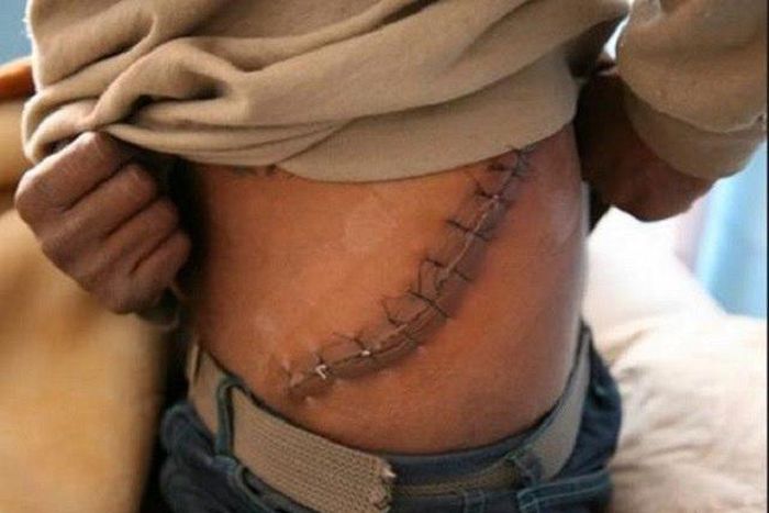 Nigerian kidney sellers flood to Middle East