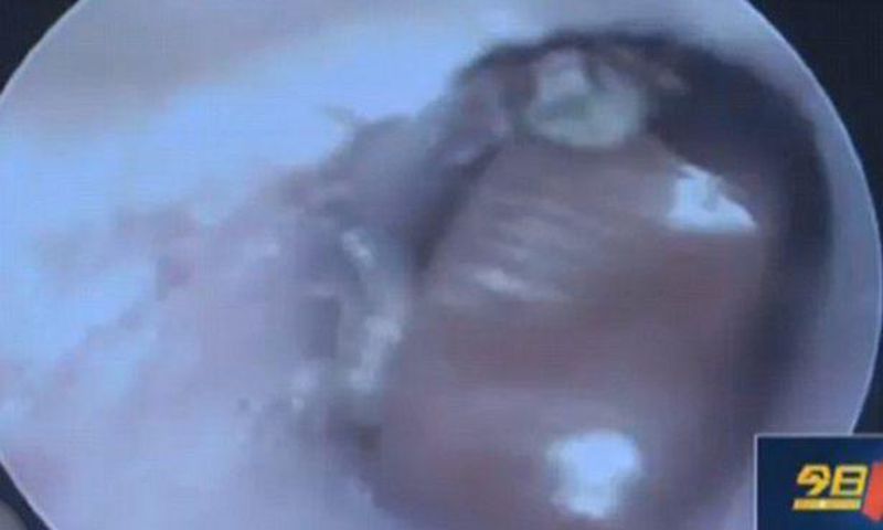 Cockroach gives birth to 25 babies in man's ear