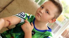 A 9-year-old boy needs plastic surgery after a neighbour's dog bit him on his arm.