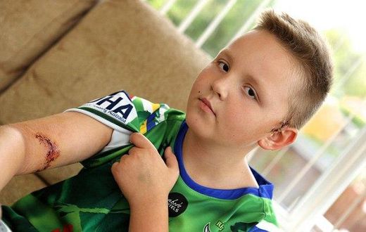 A 9-year-old boy needs plastic surgery after a neighbour's dog bit him on his arm.
