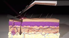Animation showing how the Skarp Laser Razor works