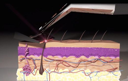 Animation showing how the Skarp Laser Razor works