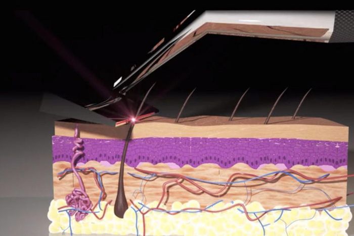 Animation showing how the Skarp Laser Razor works