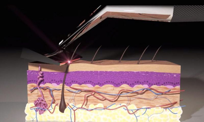 Animation showing how the Skarp Laser Razor works