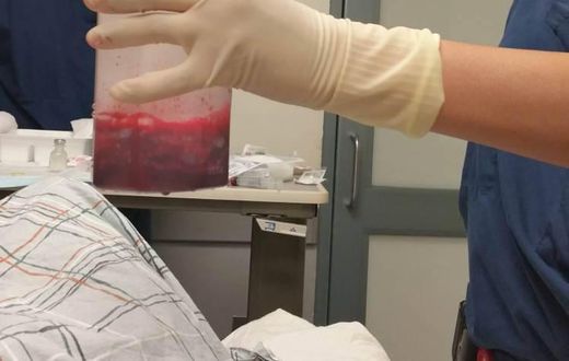 This amount of blood had to be extracted from his penis to relieve him.