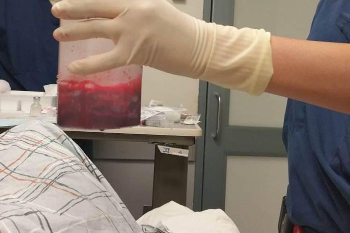 This amount of blood had to be extracted from his penis to relieve him.