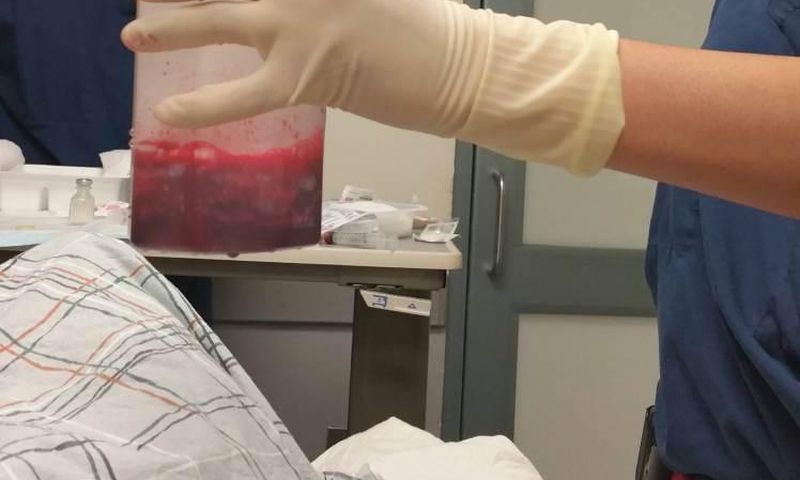 This amount of blood had to be extracted from his penis to relieve him.