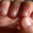 Damaged fingernails