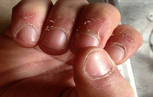 Damaged fingernails