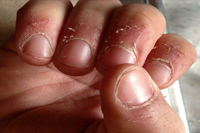 Damaged fingernails