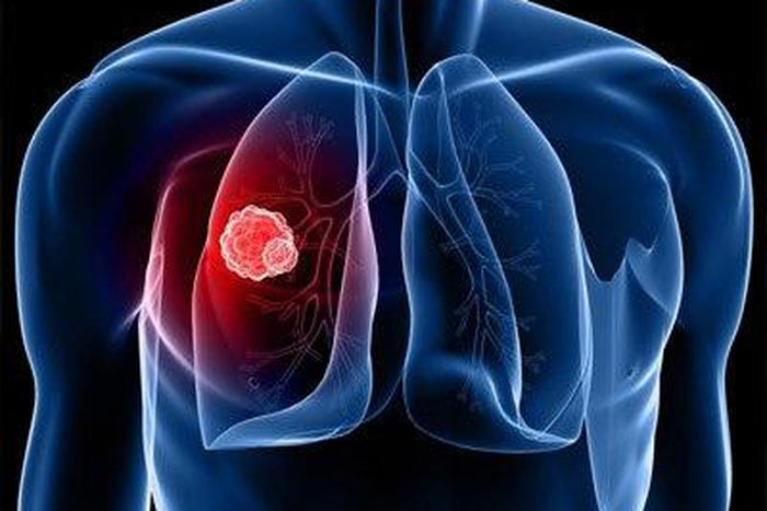 ___3888150___https:______static.pulse.com.gh___webservice___escenic___binary___3888150___2015___6___19___20___lung-cancer