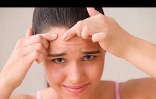 Forehead acne