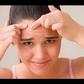 Forehead acne