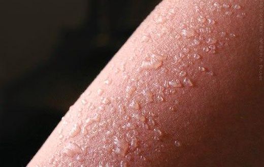Sunburn blisters