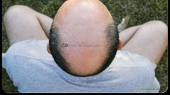 Man with bald head