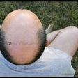 Man with bald head
