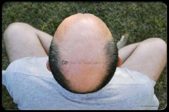 Man with bald head