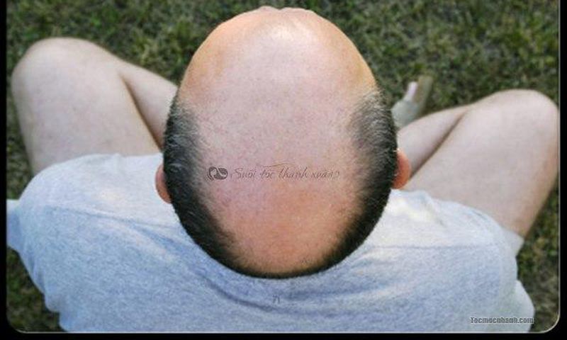 Man with bald head