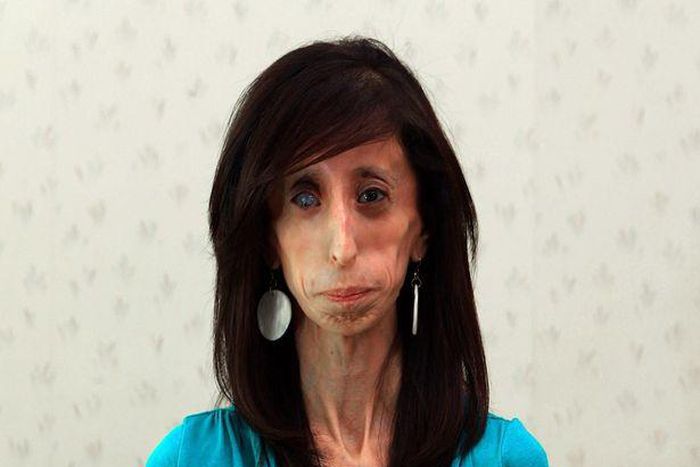 Lizzie Velasquez