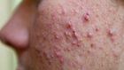 ___4107028___https:______static.pulse.com.gh___webservice___escenic___binary___4107028___2015___8___26___15___sattvik-organics-acne-treatment-kit-reviews-isotretinoin-get-does-rid-scars-ma8