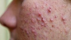 ___4107028___https:______static.pulse.com.gh___webservice___escenic___binary___4107028___2015___8___26___15___sattvik-organics-acne-treatment-kit-reviews-isotretinoin-get-does-rid-scars-ma8