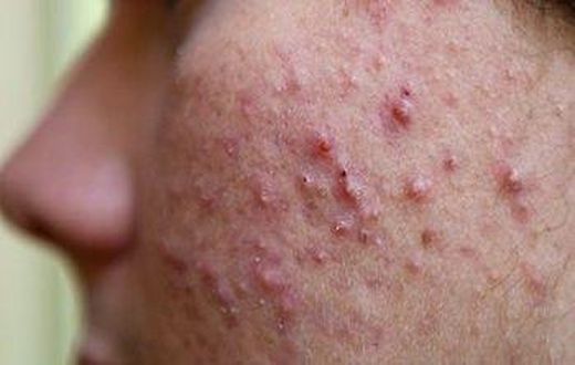 ___4107028___https:______static.pulse.com.gh___webservice___escenic___binary___4107028___2015___8___26___15___sattvik-organics-acne-treatment-kit-reviews-isotretinoin-get-does-rid-scars-ma8