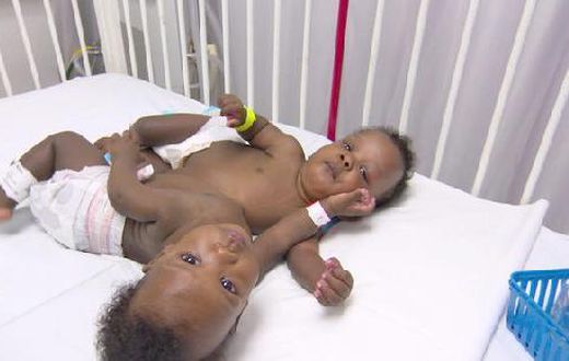 ___3868309___https:______static.pulse.com.gh___webservice___escenic___binary___3868309___2015___6___15___18___marian-michelle-conjoined-twins