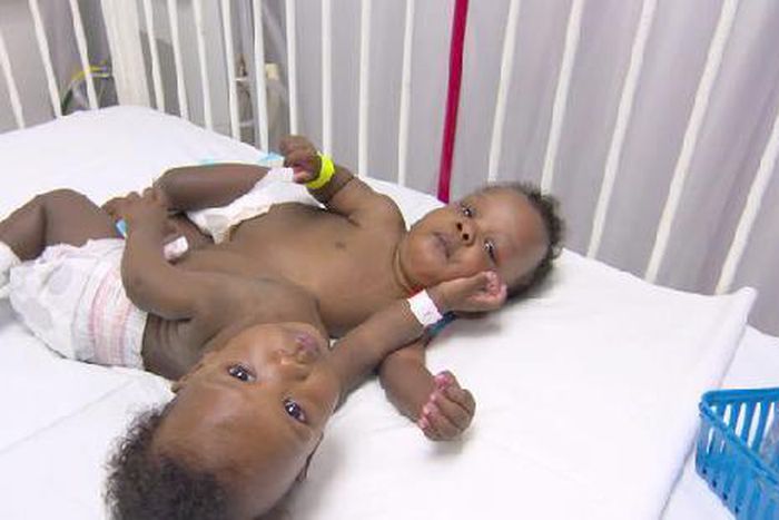 ___3868309___https:______static.pulse.com.gh___webservice___escenic___binary___3868309___2015___6___15___18___marian-michelle-conjoined-twins