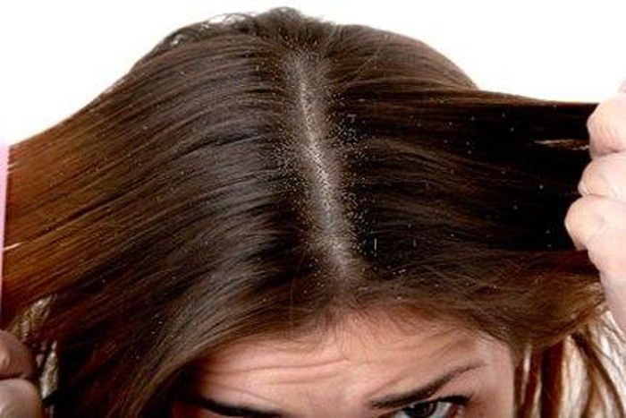 Dry, flaky scalp