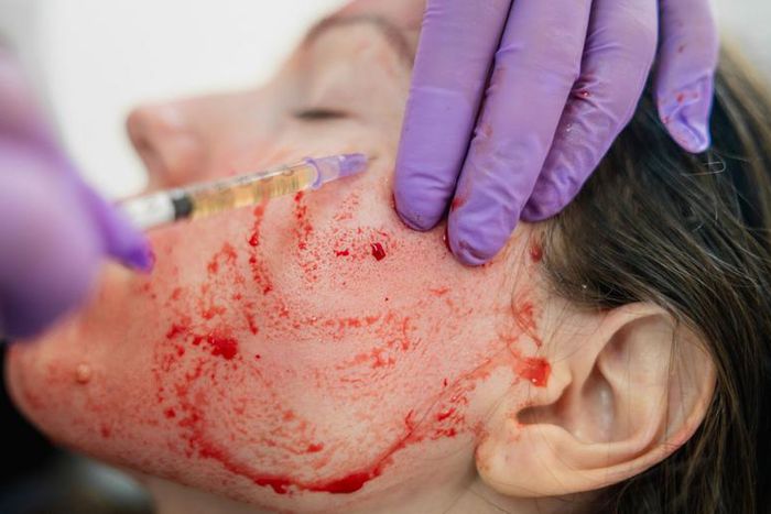 Vampire Facials Might Be Causing HIV