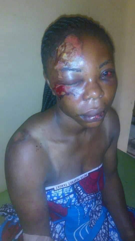 I simply can’t do without him – Woman whose abusive man disfigured her face beyond treatment (photo)